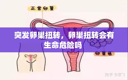 突发卵巢扭转，卵巢扭转会有生命危险吗 